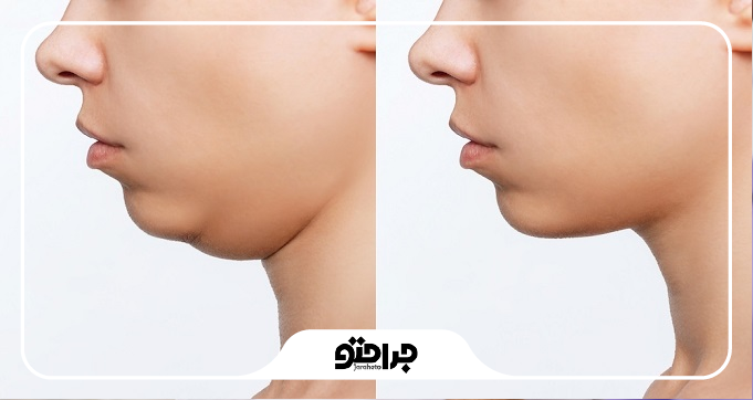 کاندیدای مناسب برای ساکشن غبغب در جوادیه