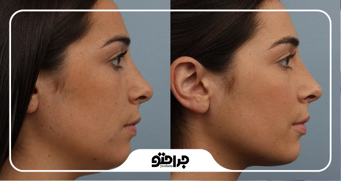 چه افرادی نباید ساکشن غبغب انجام دهند؟