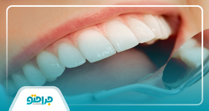 لمینت دندان بهتر است یا کامپوزیت؟