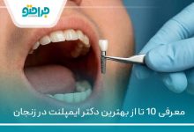 بهترین دکتر ایمپلنت در زنجان