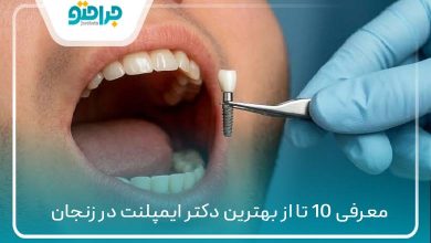 بهترین دکتر ایمپلنت در زنجان