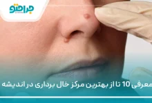 معرفی 10 تا از بهترین مرکز خال برداری در اندیشه ✅【سال1405】