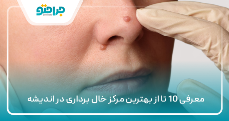 معرفی 10 تا از بهترین مرکز خال برداری در اندیشه ✅【سال1405】