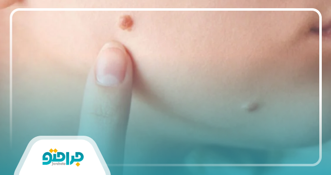 روشهای خالبرداری در اندیشه کداماند؟
