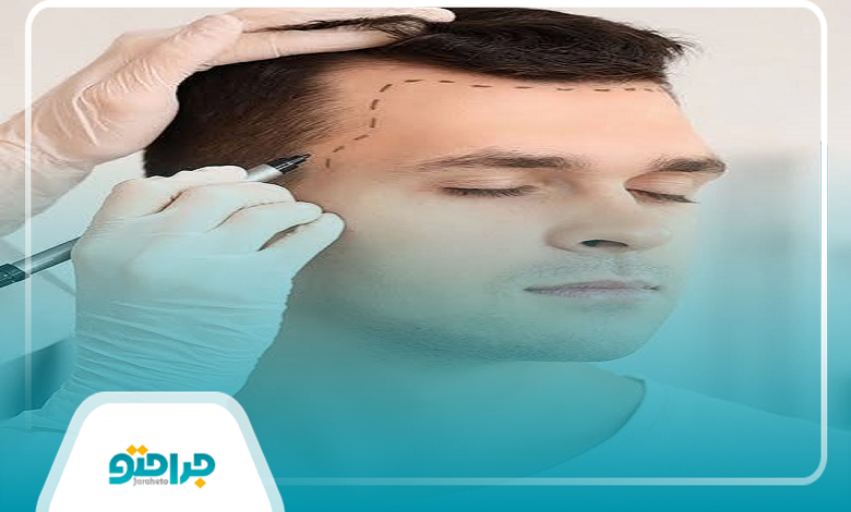 مهم ترین علت ریزش مو