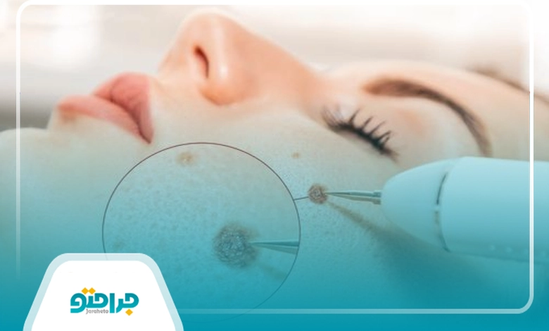 خال گوشتی را چگونه می‌توان برداشت؟