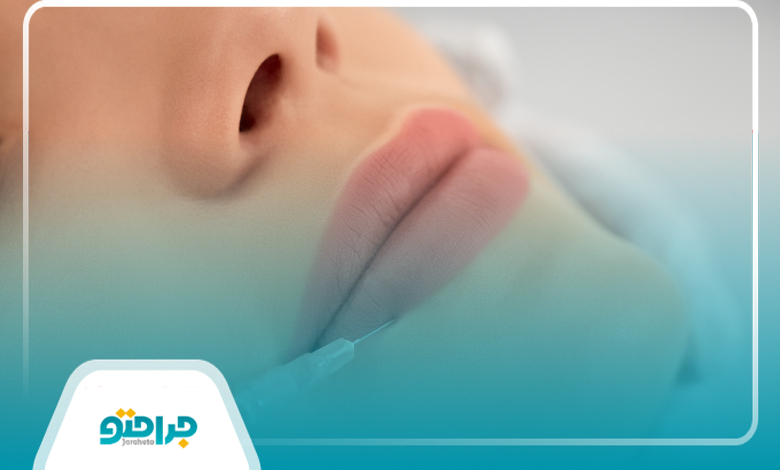 مزایای تزریق ژل لب در زعفرانیه